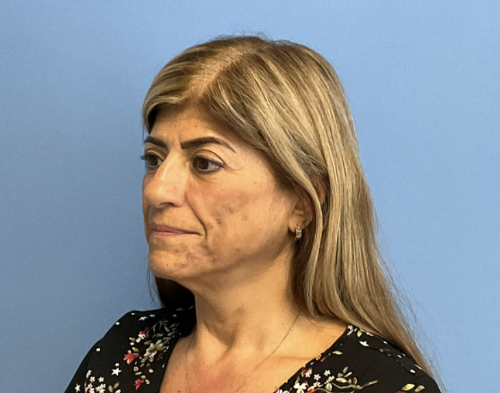 Facelift--Case-Study-2470 | Before Face